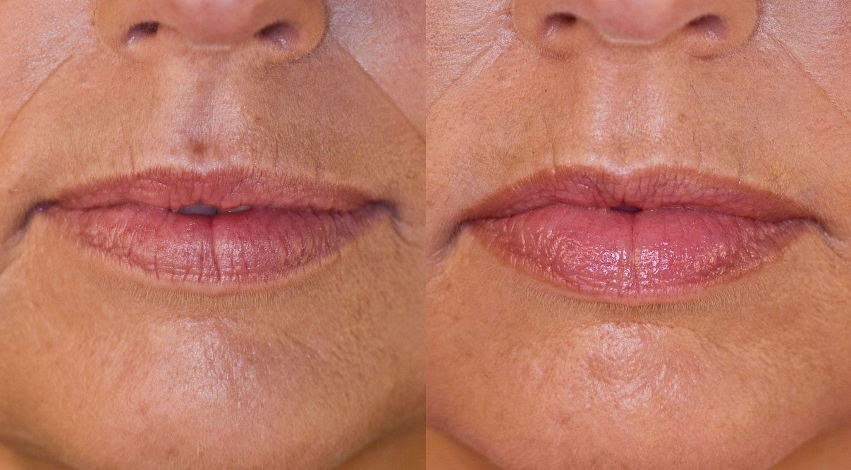 teoxane lip-filler-before-and-after
