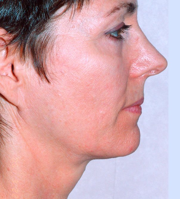 A profile view of a lady's face following thermage treatmen