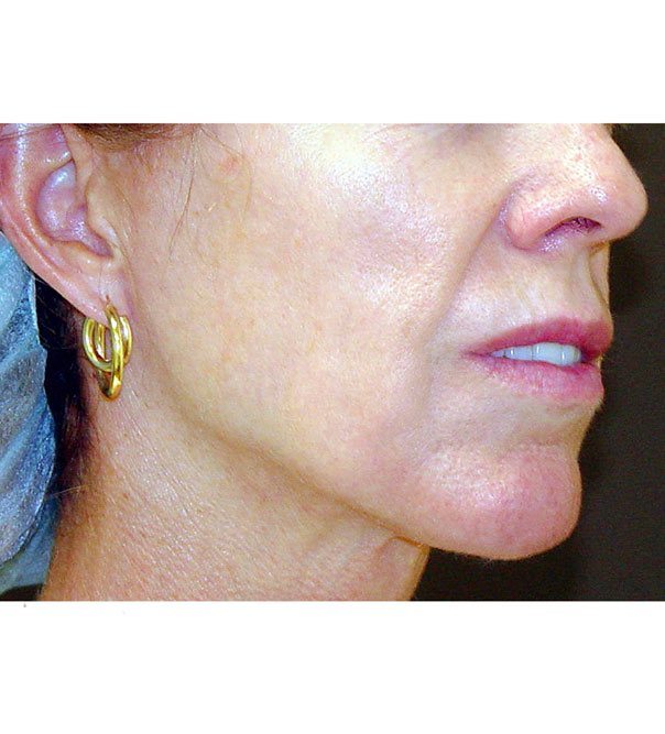 The lower face after thermage treatment