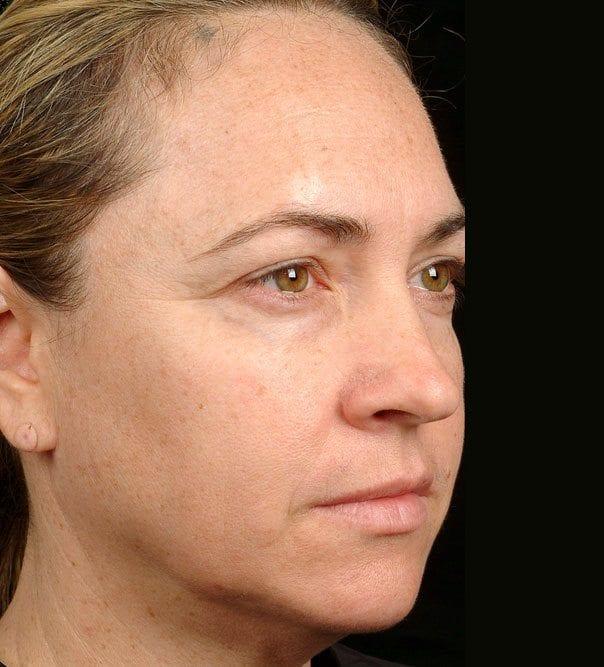 thermage treatment after results