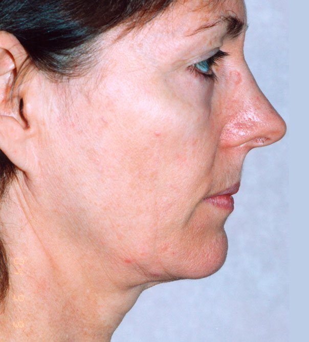 A profile view of a lady before thermage treatment