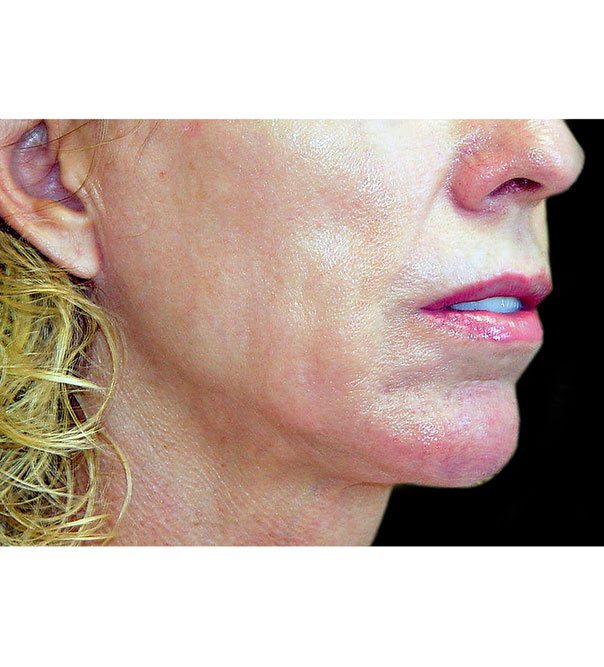 A lady's lower face before thermage