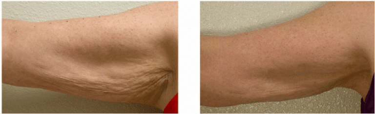 Thermage Before and After | The Cosmetic Skin Clinic