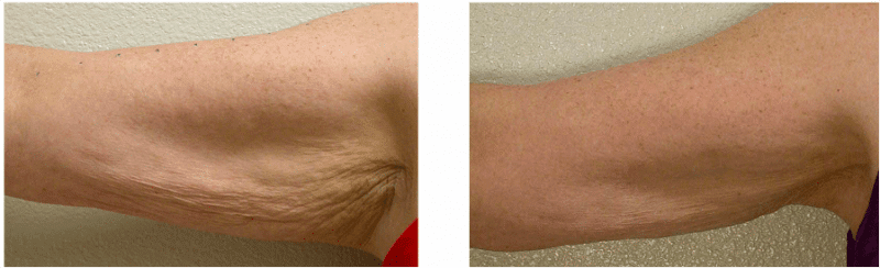 Thermage Arms Before and After Thermage Arms Before and After