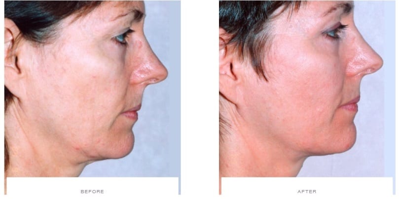 Thermage Cheeks Before and After Thermage Cheeks Before and After