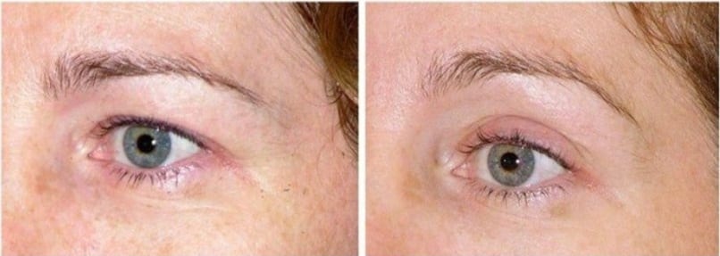 Thermage Eyes Before and After