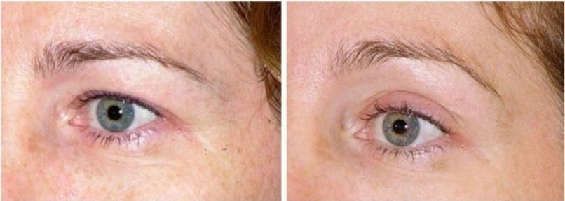 Thermage Eyes Before and After Thermage Eyes Before and After
