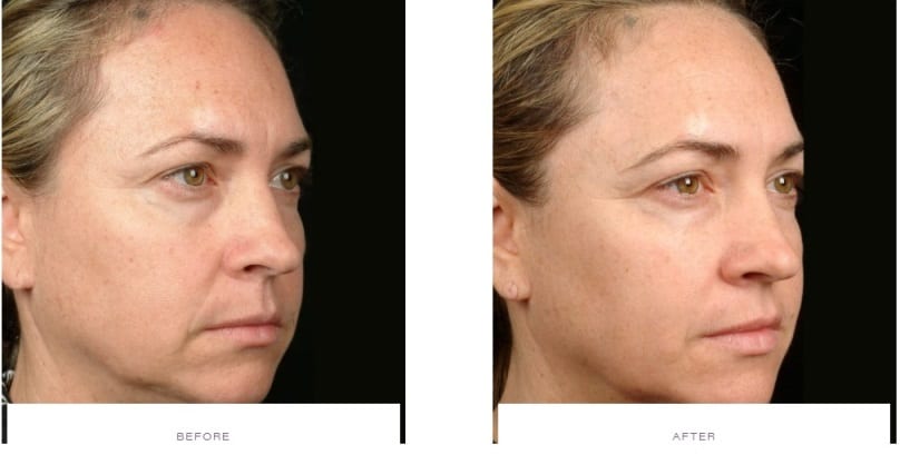 Thermage Face Before and After