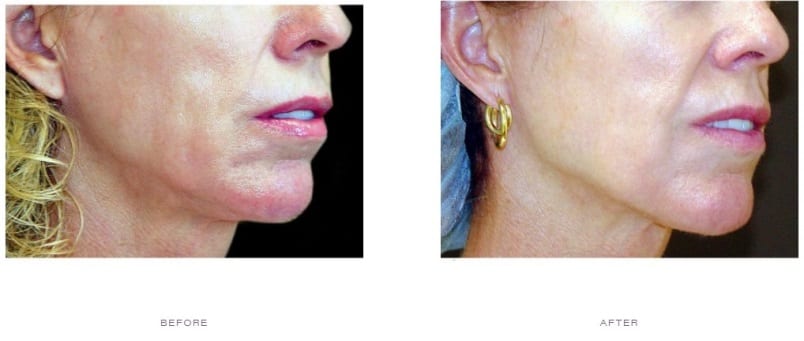 Thermage Neck Before and After