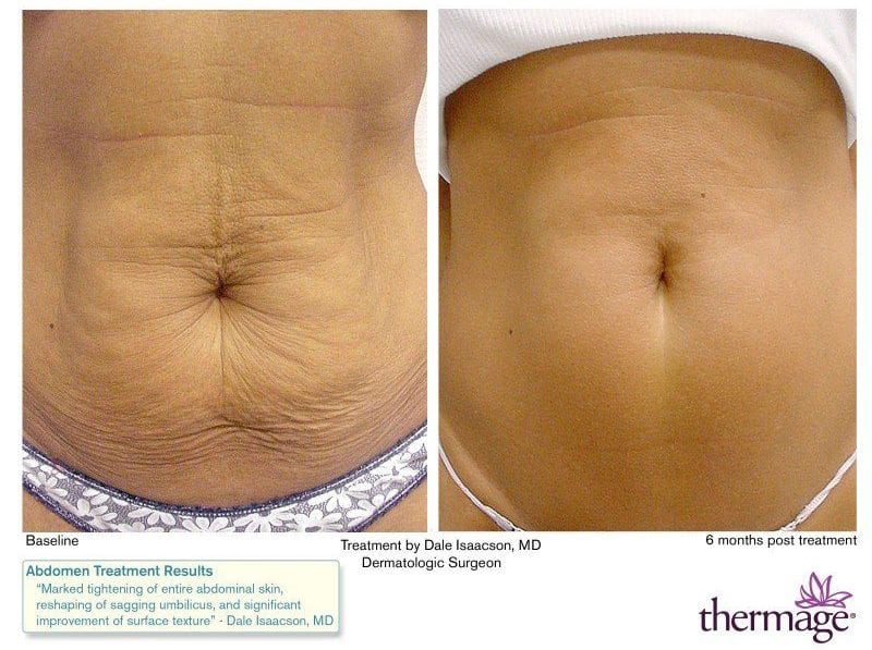 Thermage Stomach Before and After Thermage Stomach Before and After