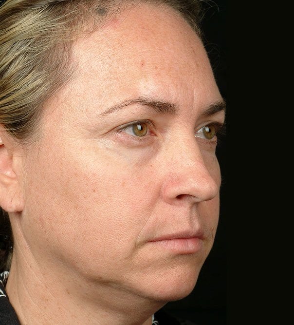 Thermage Before Treatment