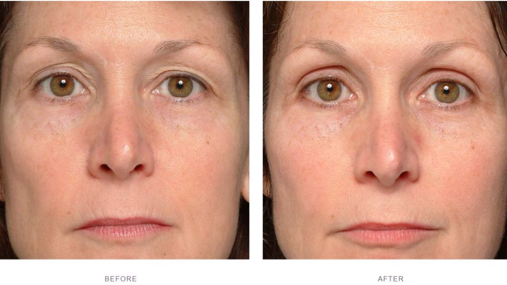thermage brow lift before and after