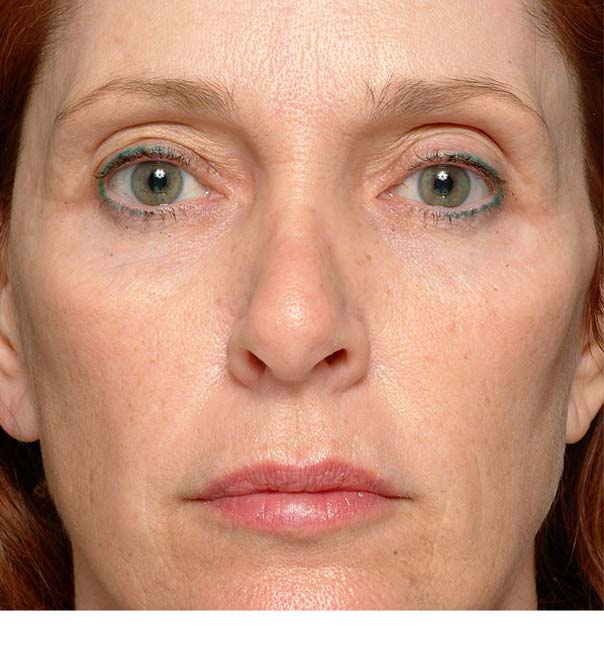 A before image of a lady about to have thermage treatment on her eyes