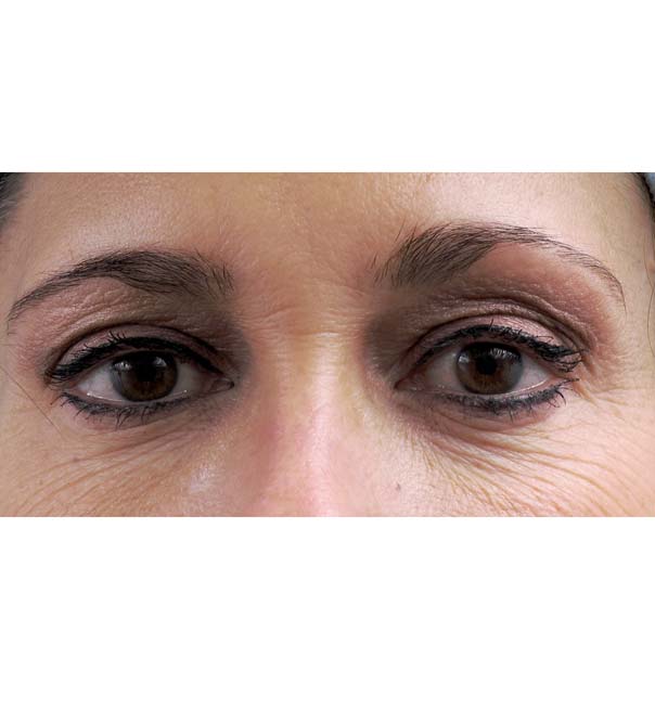 A close up of eyes before thermage treatment