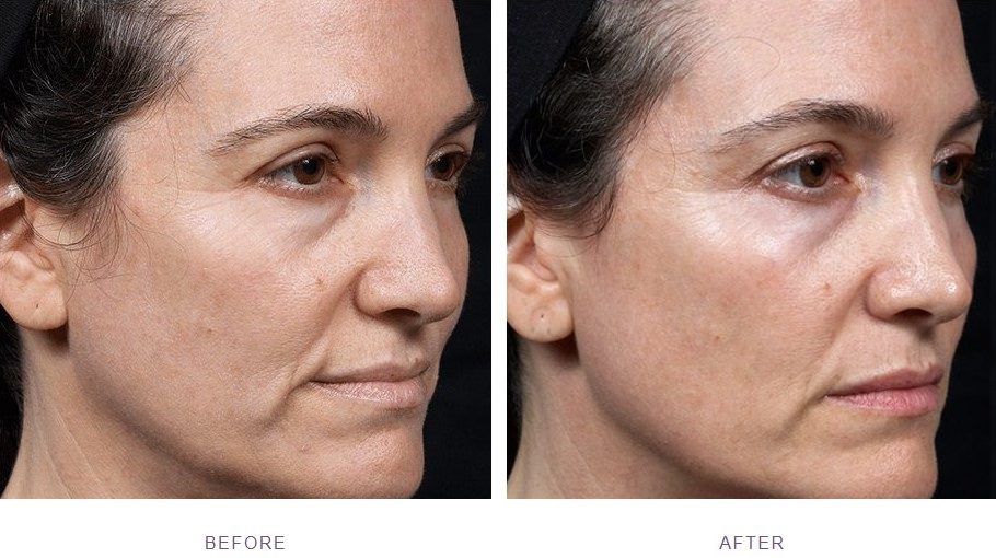 silhouette soft facelift treatment before after