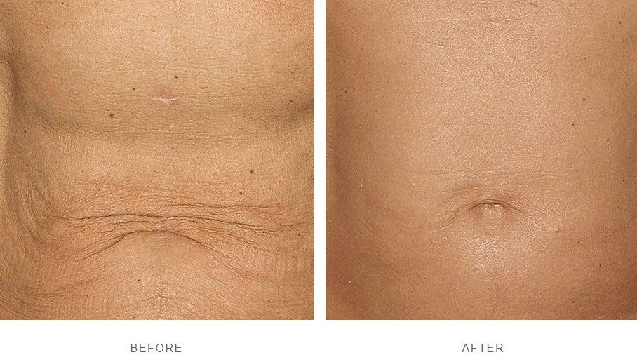 silhouette soft facelift treatment before after