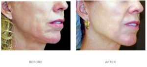 thermage mid face treatment before after