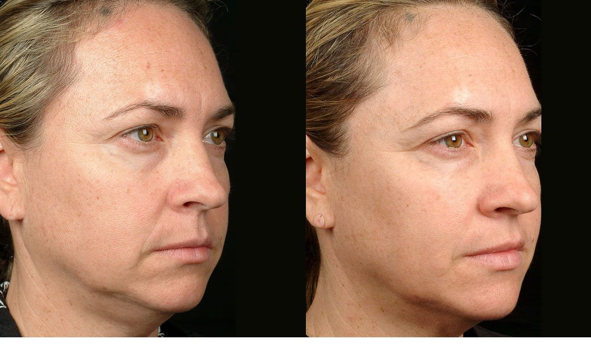 thermage non surgical facelift jowl lift before and after