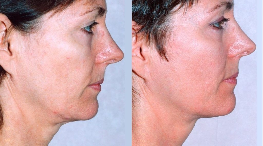 thermage skin tightening before and after