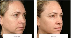 thermage skin tightening treatment before after