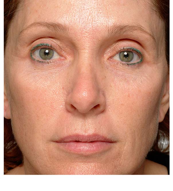 Thermage Skin Tightening After Photo