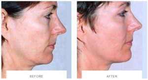 thermage treatment before after