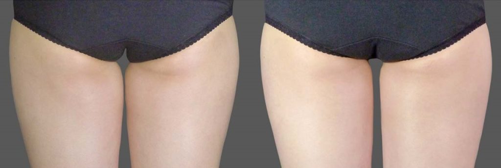 thigh coolsculpting before and after, fat freezing thigh fat before after
