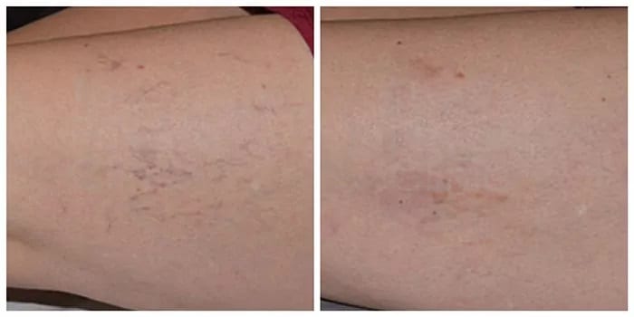 Thread Vein Removal Before and After