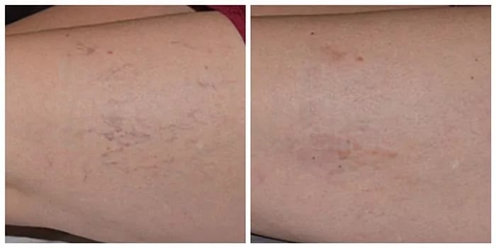 Thread veins removal treatment before and after Thread Vein Removal Before and After