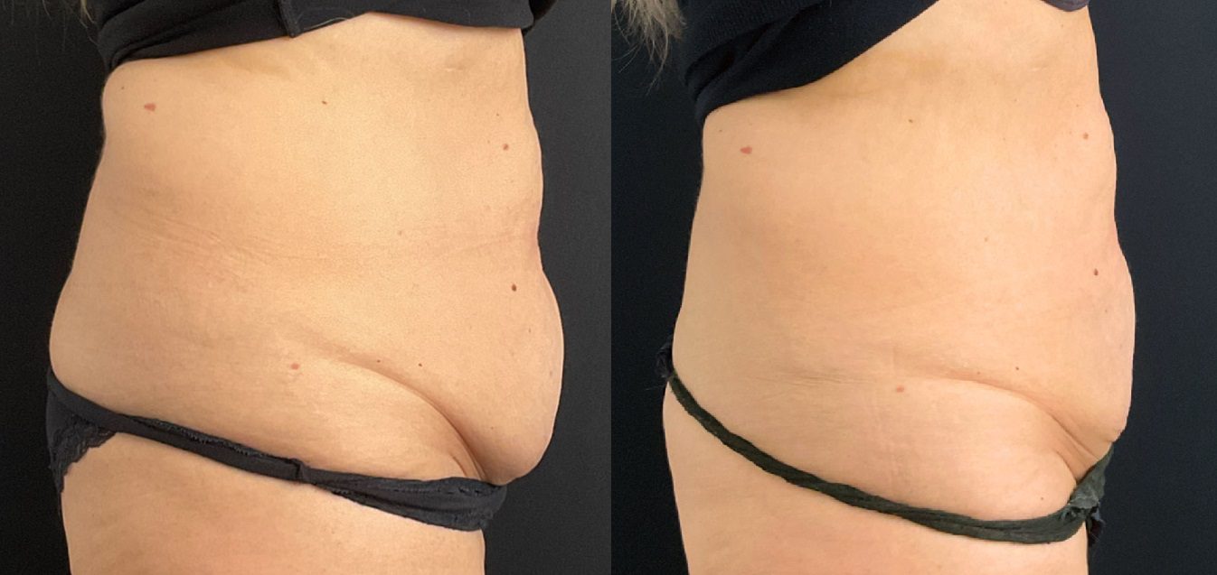 tummy fat coolsculpting fat freezing before and after