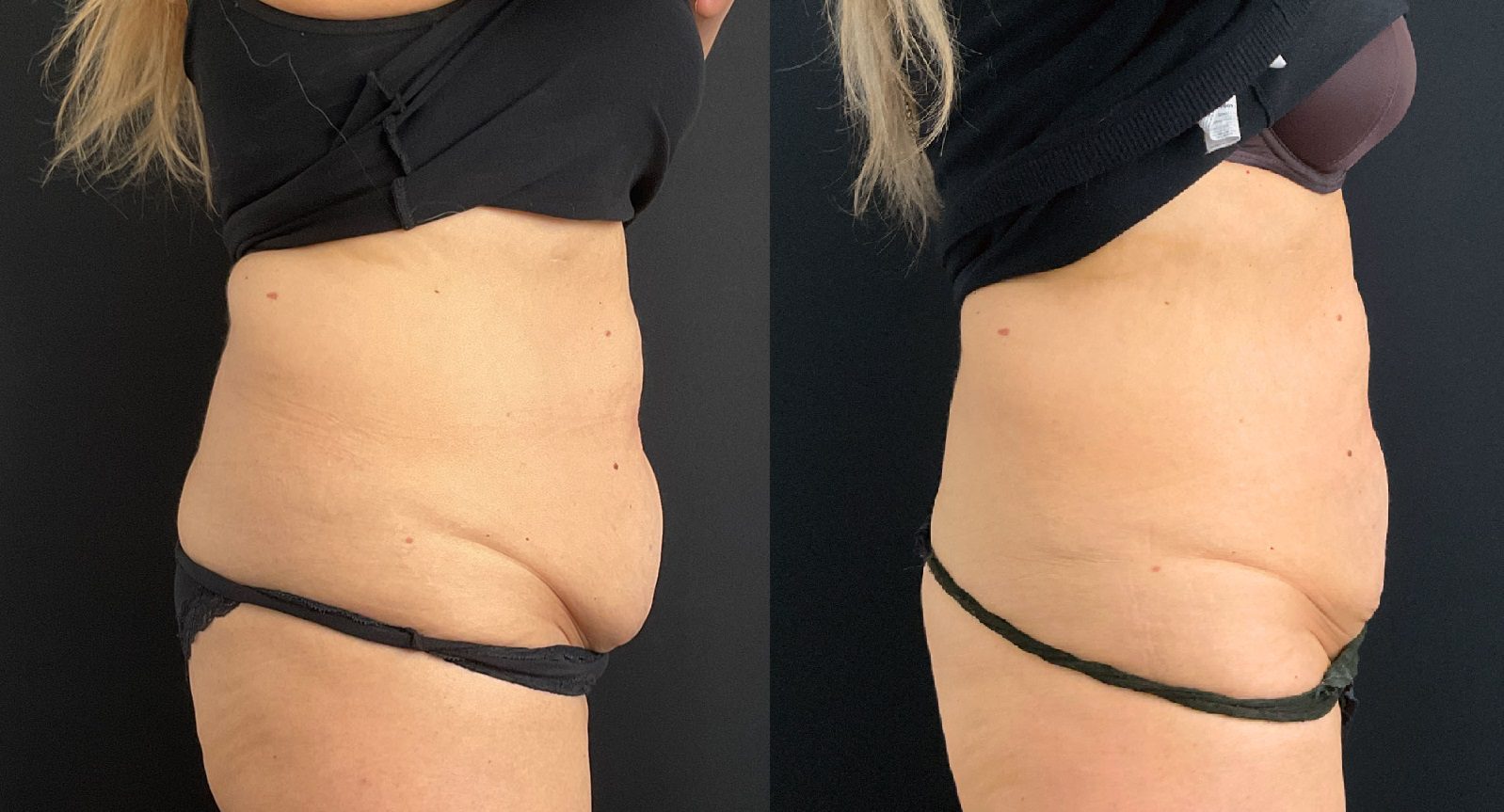 tummy fat coolsculpting fat freezing side before and after