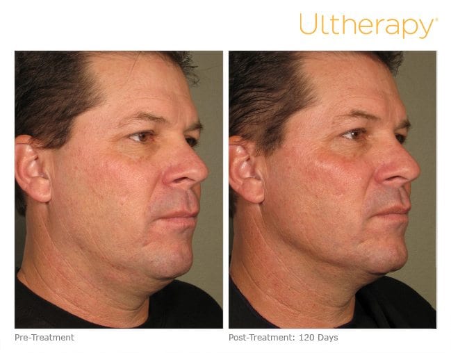 Ultherapy Before and After Full Face