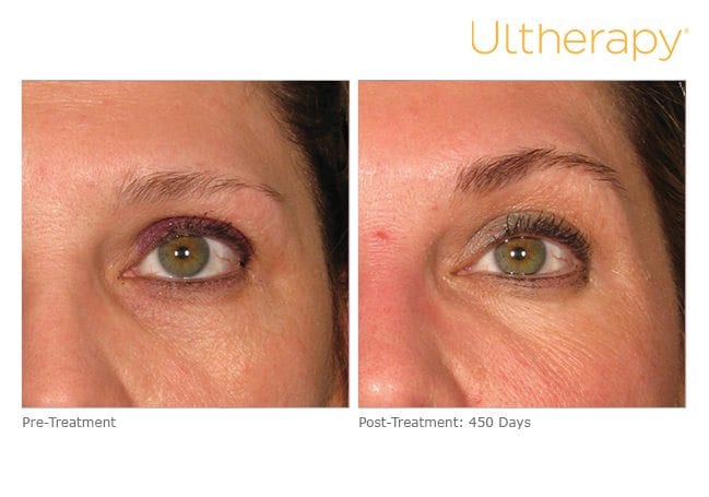 Ultherapy Brow Lift before after