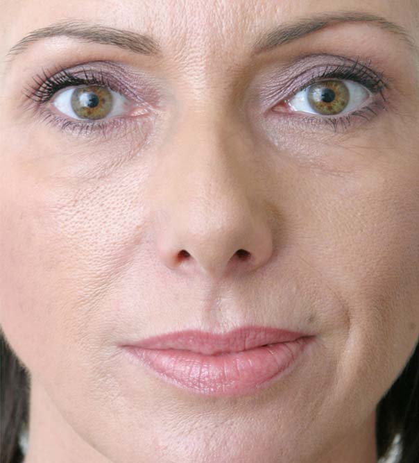 A close up of a lady following Restylane treatment to the lower face and lips