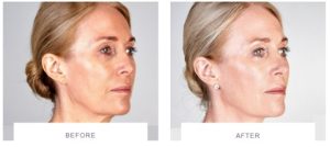 ultherapy before after face rejuvenation