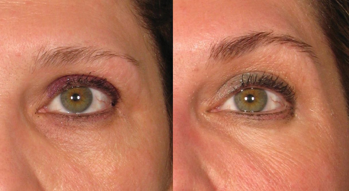 ultherapy before and after brow lift - non surgical brow lift