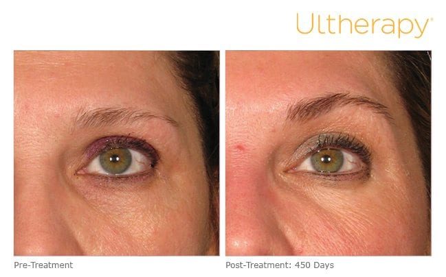Ultherapy Before and After Brows