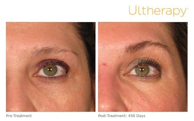 Ultherapy Brows Before and After Ultherapy Before and After Brows