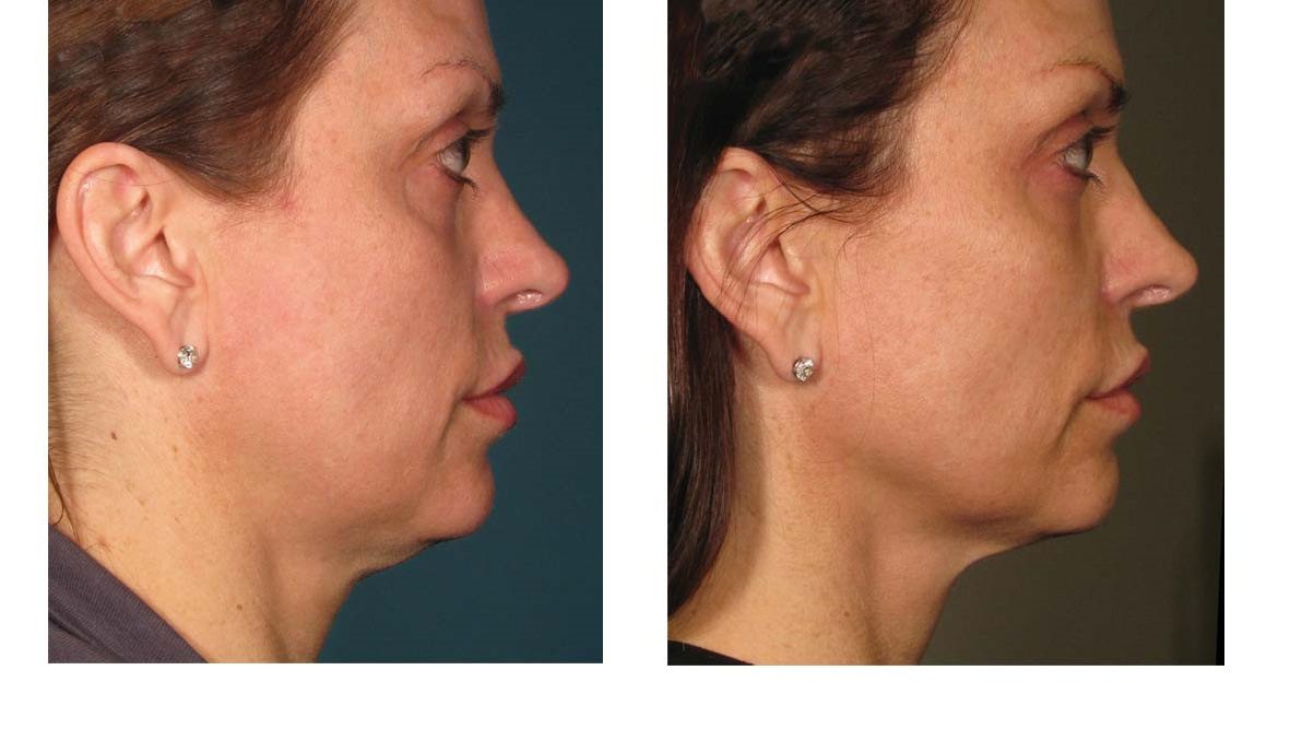 ultherapy before and after for neck lift - nonsurgical neck lift