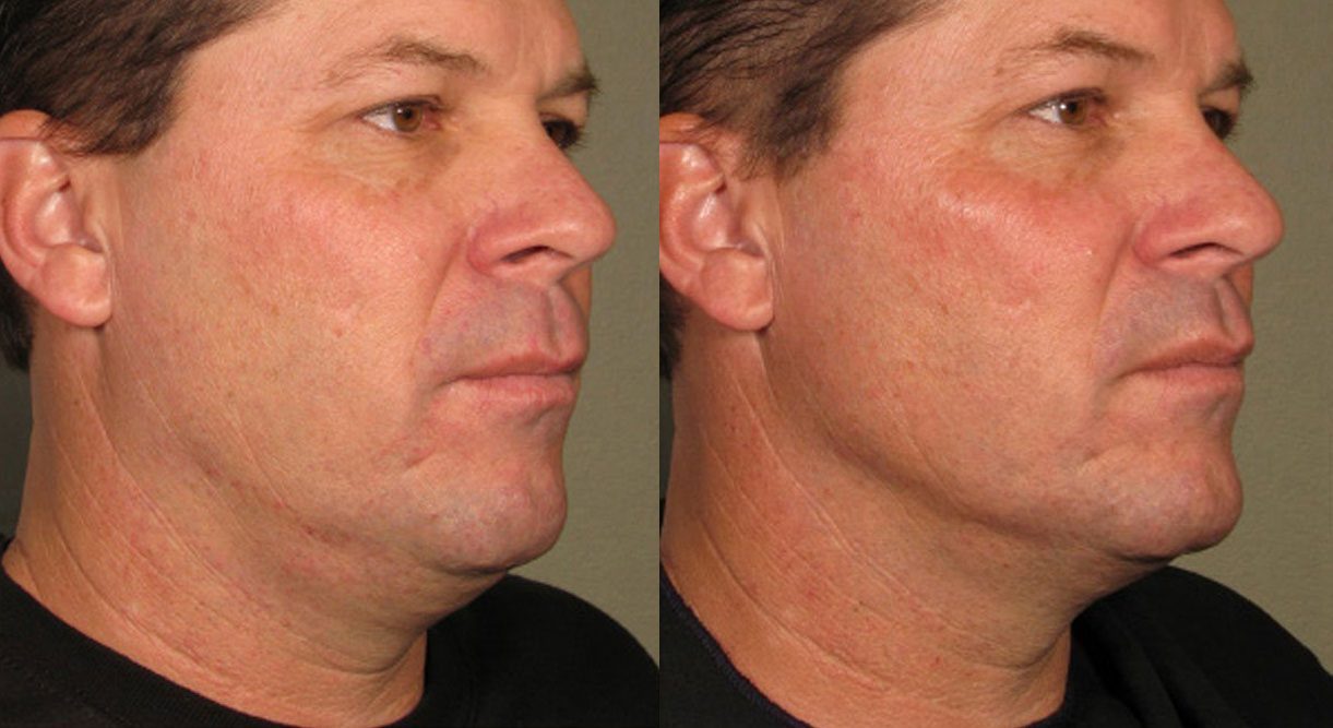 ultherapy before and after jaw lift - jawline contouring
