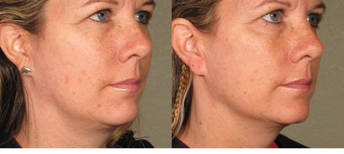 ultherapy before and after jawline contouring - neck lift