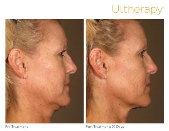 Ultherapy Before and After Jawline Ultherapy Before and After Jawline