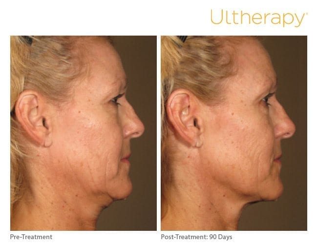 Ultherapy Before and After Jawline