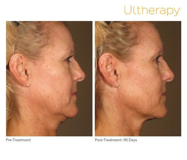 Ultherapy Before and After Jawline