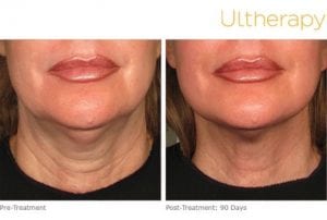 Ultherapy Before and After Lips