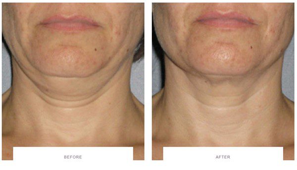 ultherapy before and after neck