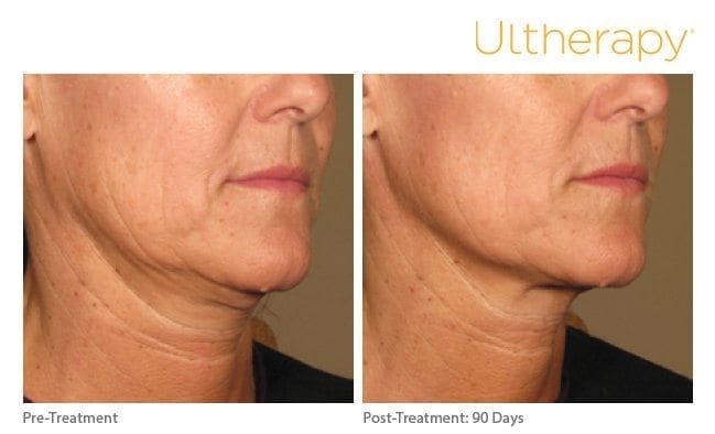 Ultherapy Before and After Neck