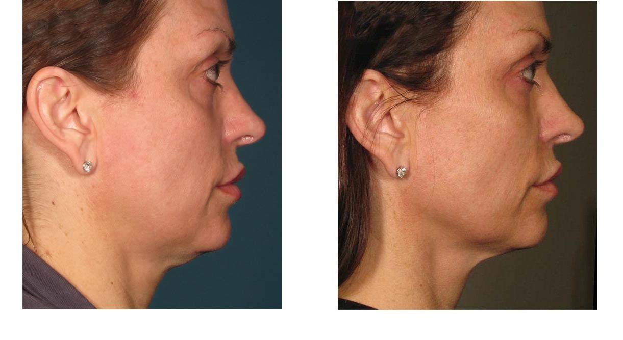 ultherapy before and after neck lift