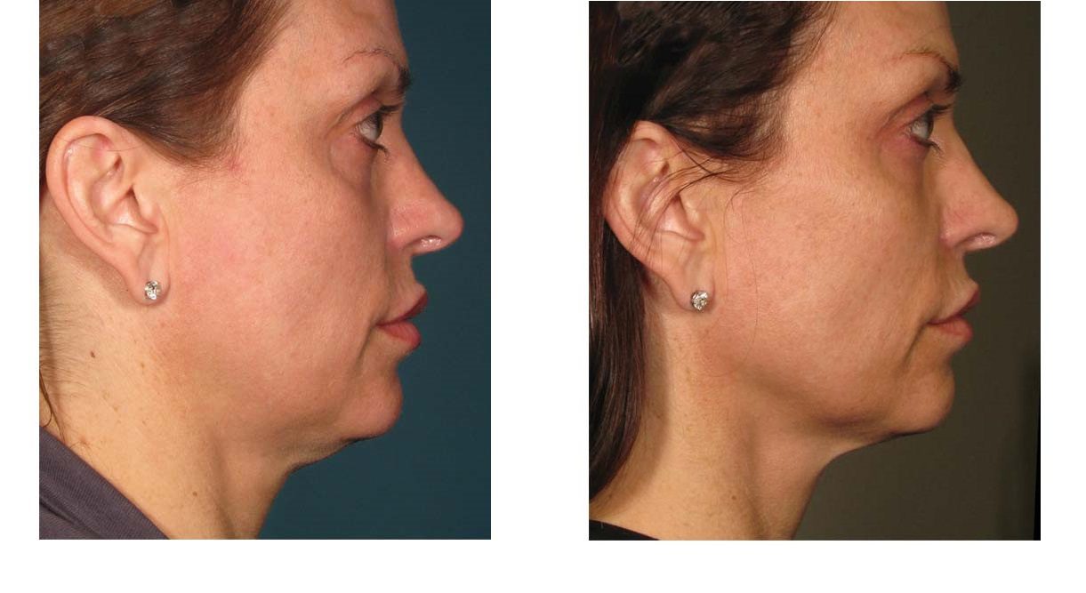 Neck Lift using Botox, Thread Lift, Ultherapy Non surgical Neck Lift