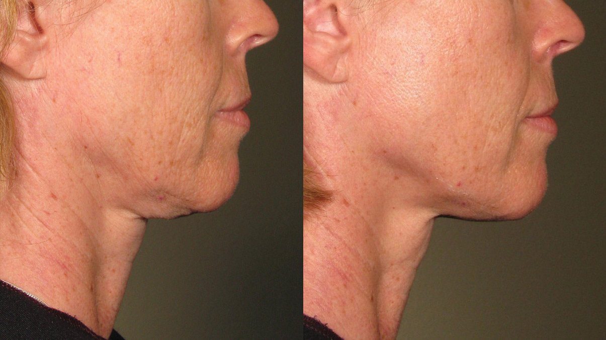 ultherapy before and after sagging neck saggin skin